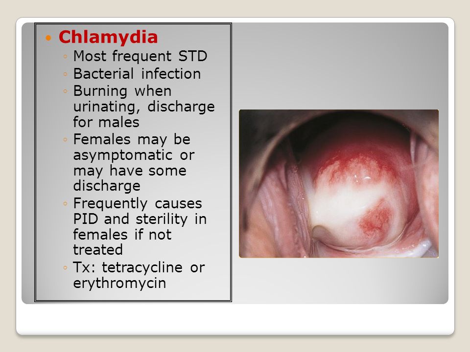 Gay male chlamydia